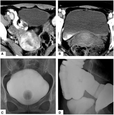 An unexpected complication after removing bladder foreign body: a case report